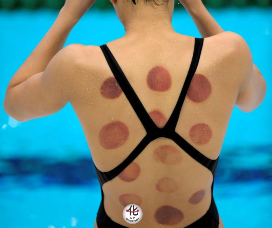 Marques de ventouses chez un sportif de haut niveau après une séance thérapeutique