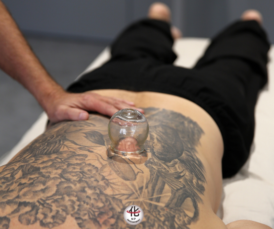 Ventouses en verre utilisées en médecine chinoise lors d'un traitement thérapeutique